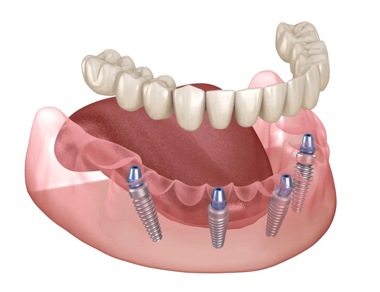 Full Arch Implants Model