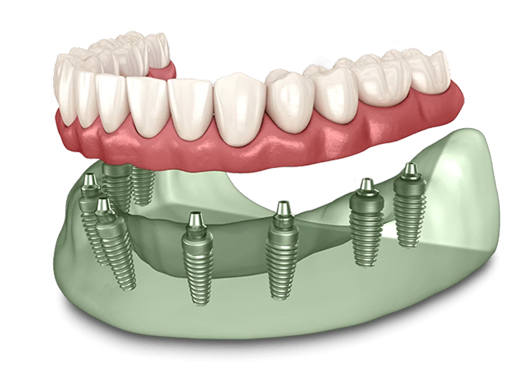 Full Arch Implants Model